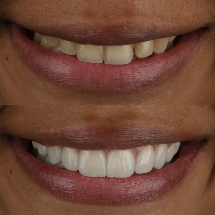Real patient veneers before and after