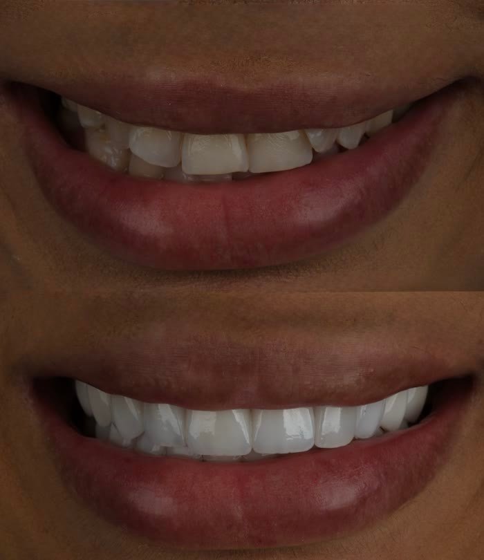 Real patient veneers before and after