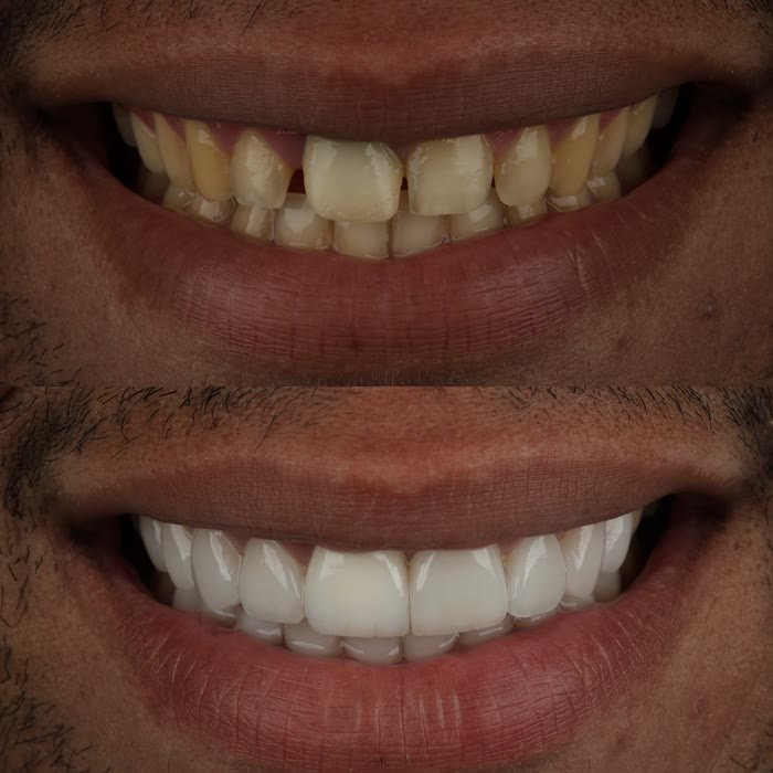 Real patient veneers before and after