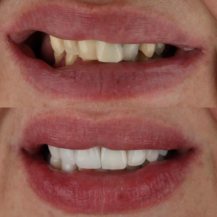 Real patient veneers before and after