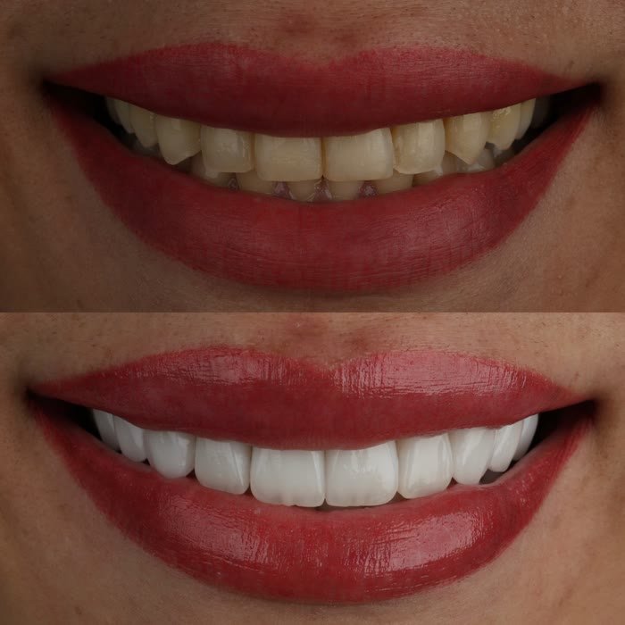Real patient veneers before and after