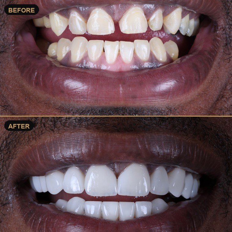 Antes y después de carillas dentales — Lael Dental Esthetic
