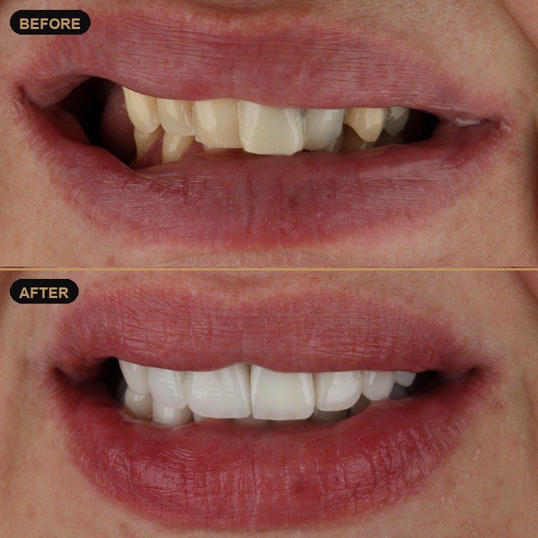 Antes y después de carillas dentales — Lael Dental Esthetic