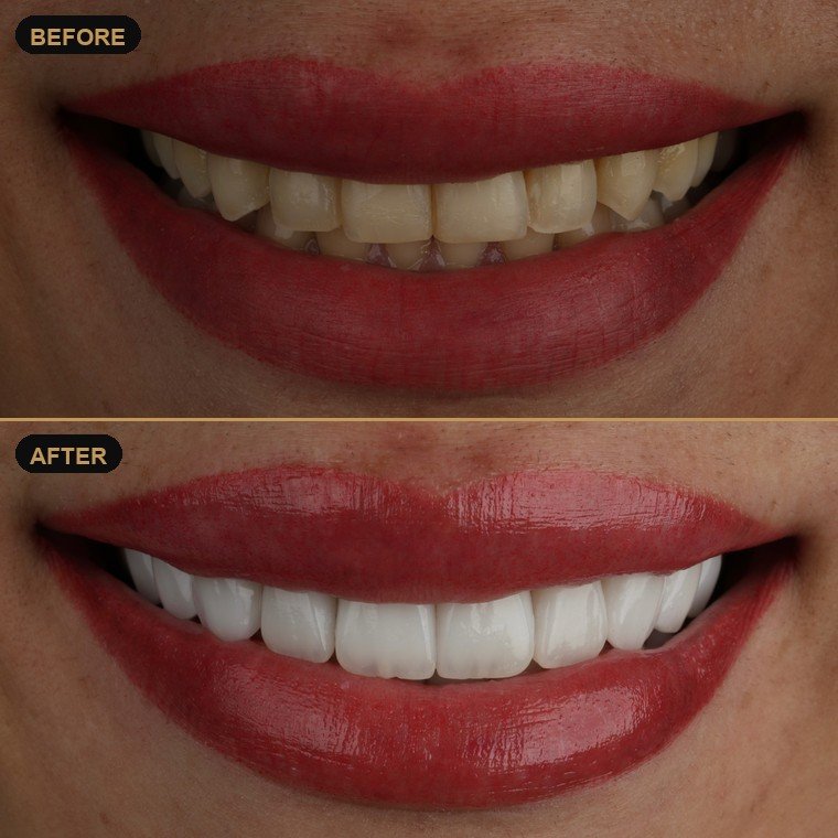 Antes y después de carillas dentales — Lael Dental Esthetic