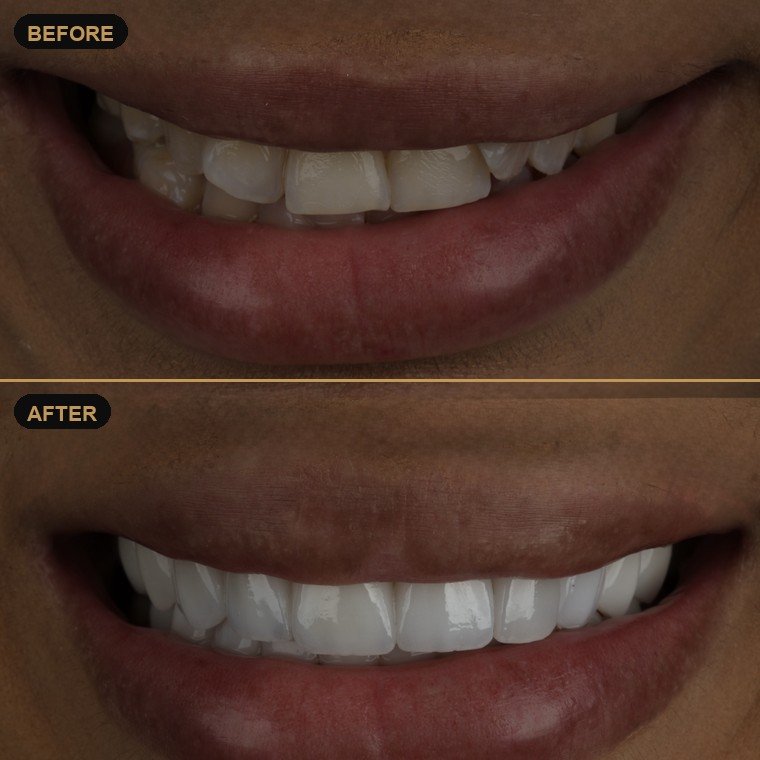 Antes y después de carillas dentales — Lael Dental Esthetic