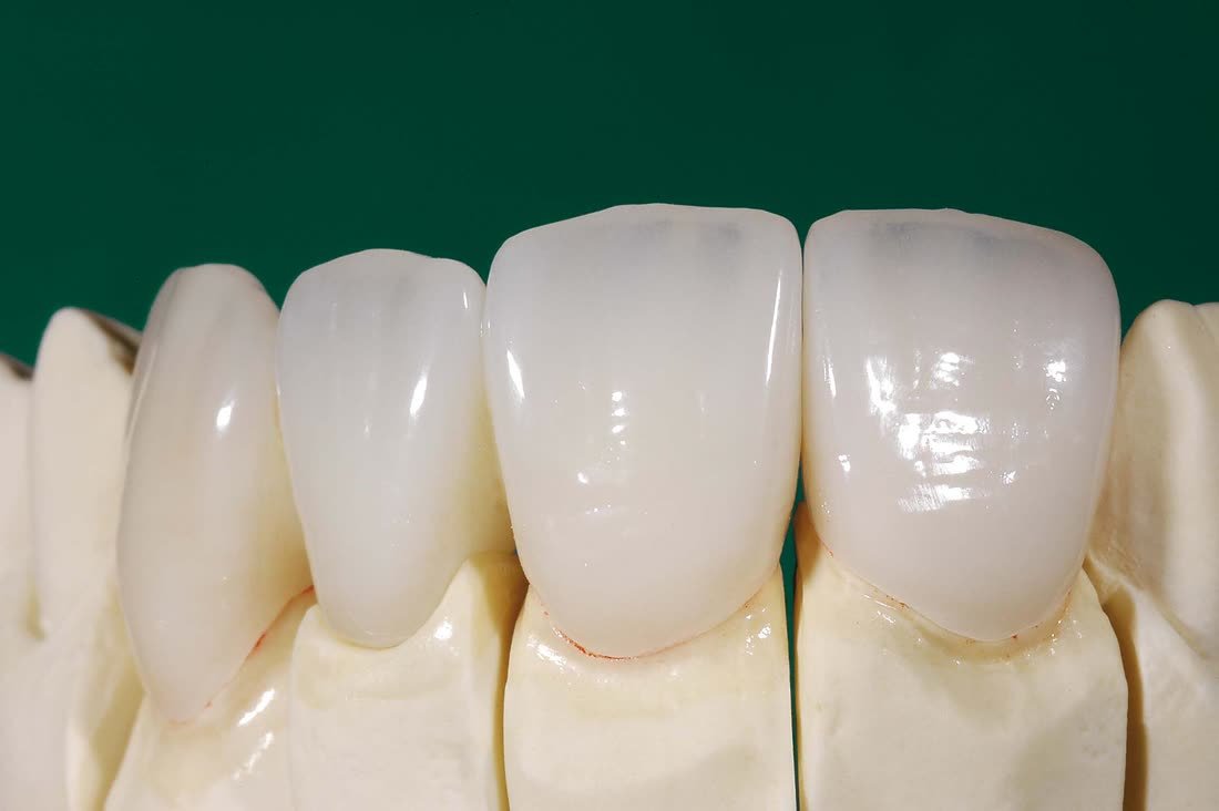 Finished e.max porcelain veneers on a model