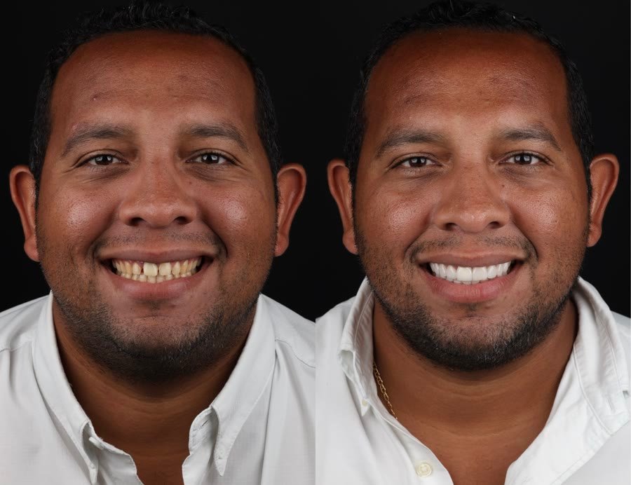 Real patient before and after porcelain veneers