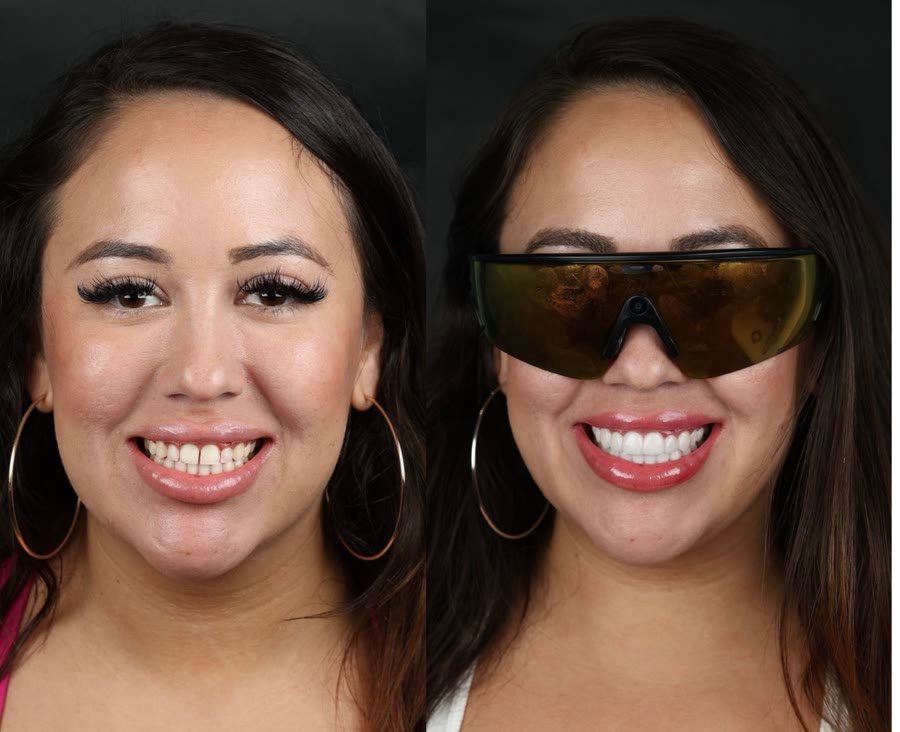Real patient before and after porcelain veneers