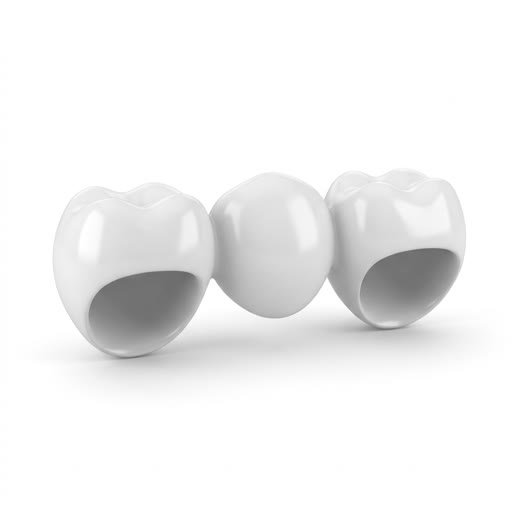 Dental bridge illustration